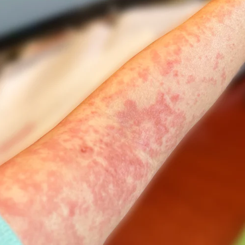 Marisol before, 7 days